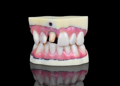 Actualmente, los laboratorios operan en un espacio muy competitivo donde la diferenciación depende del dominio del flujo de trabajo digital y la expansión hacia nuevos productos y servicios”, dijo Barry Diener, Líder de Ventas del Segmento Dental de Stratasys